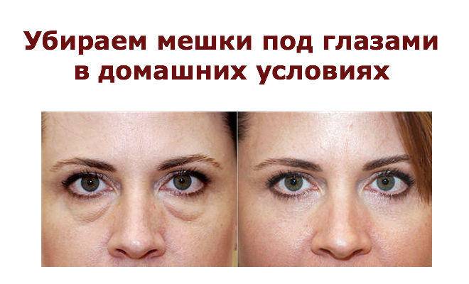 Убираем мешки под глазами, отёчность в домашних условиях смотреть онлайн