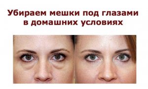 Убираем мешки под глазами, отёчность в домашних условиях