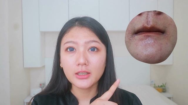 Dermatitis Perioral - Pengalaman Pribadi Kulit Wajah Penuh Nanah | My Acne Journey