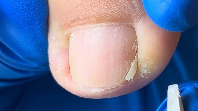 Paronychia Treatment, The Position Of The Ingrown Nail Is Very Deep!【Xue Yidao】