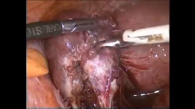 Ectopic pregnancy. Dr. Sadi Allahverdiyev, Customs Hospital, Baku, Azerbaijan смотреть онлайн