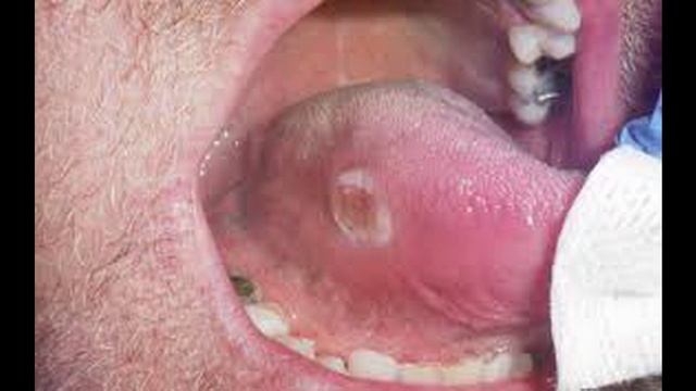 Каковы ранние признаки рака языка?﻿ (подкаст) смотреть онлайн