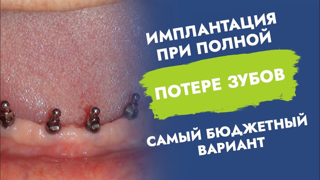 Имплантация при полной потере зубов. Самый бюджетный вариант. смотреть онлайн