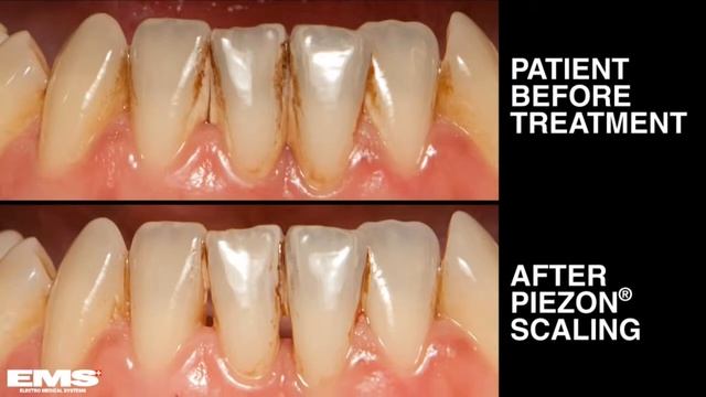 До и после комплексной гигиенической чистки смотреть онлайн
