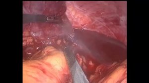 Laparoscopic splenectomy Лапароскопическая спленэктомия