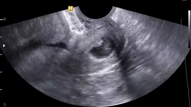 Окклюзия наружного зева шейки матки. Серозоцервикс. Полип ц/канала. Barto-clinic.ru смотреть онлайн