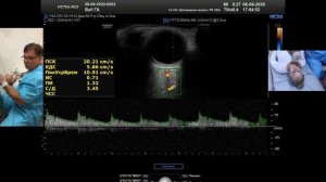 УЗИ в оценке глазного анастомоза (профессор Куликов В.П.)