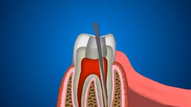 Пломбирование каналов зуба гутаперчей смотреть онлайн