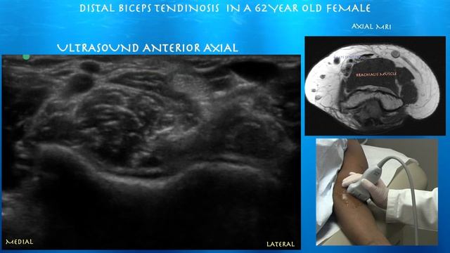 Ultrasound Of Distal Biceps Tendinosis By Probeultrasound.com