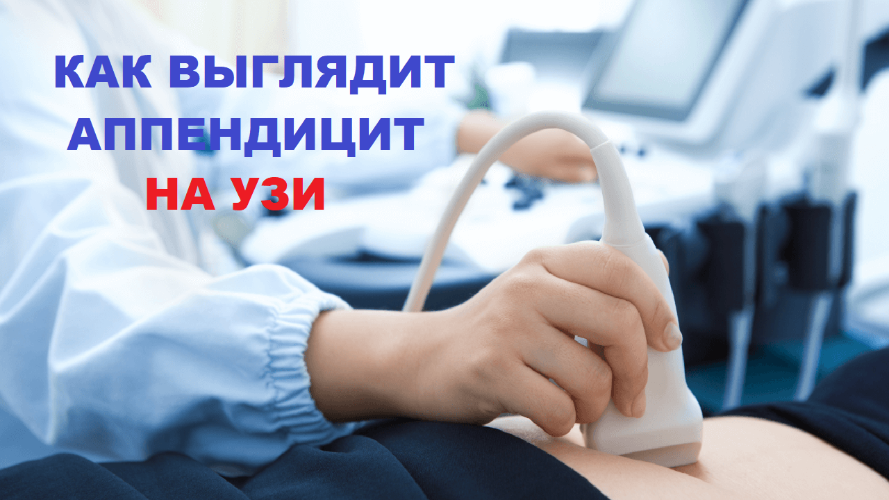 УЗИ аппендицита
