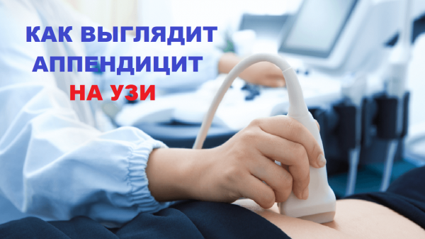 УЗИ аппендицита