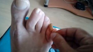 Удаление ногтя в домашних условиях