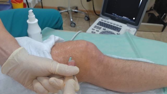 жидкость в колене при повреждении, откачивание смотреть онлайн