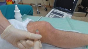 жидкость в колене при повреждении, откачивание