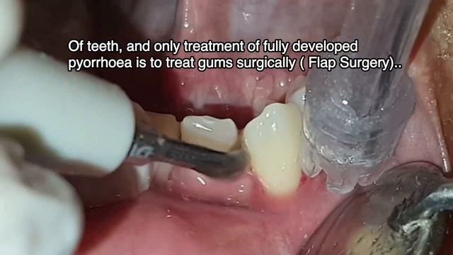 How Scaling is done ? | Teeth cleaning | Scaling and Polishing смотреть онлайн