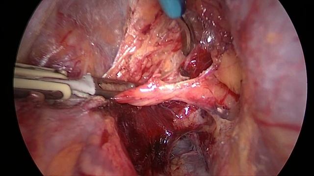 Sentinel lymph node detection for gynecological cancer. Dr Lucas Minig, Valencia Spain смотреть онлайн