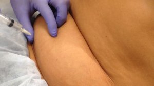 Аириском студенты учатся: семинар по введению ЛИПОЛИТИКА в область живота.