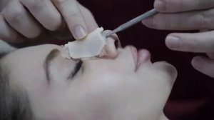 Ринопластика