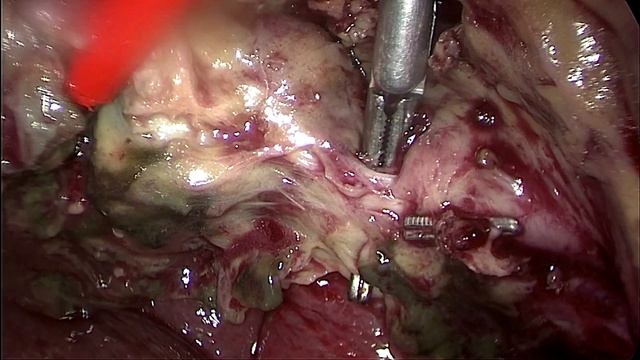 Острый гангренозный холецистит. Лапароскопическая холецистектомия при аномально расположенной артер