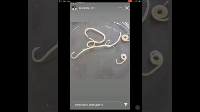 Токсокароз Toxocariasis Disgusting Video