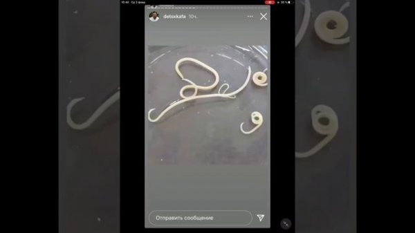 Токсокароз Toxocariasis disgusting video