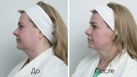 Новейший Ultraformer Mpt демонстрация процедур Mpt lifting Ultraformer и Mpt Toning Ultraformer смотреть онлайн