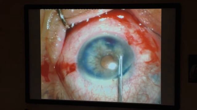 Задняя автоматизированная послойная кератопластика смотреть онлайн