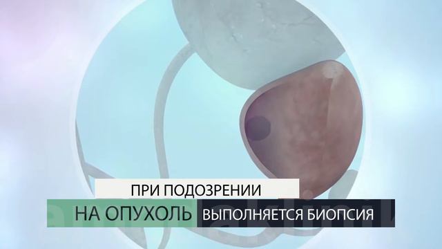 Рак предстательной железы смотреть онлайн