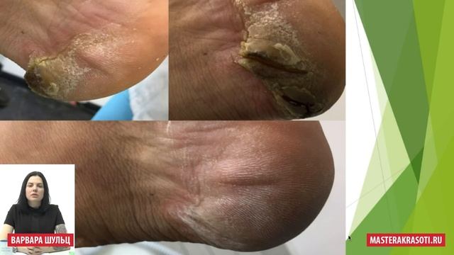 Мозоли и натоптыши: как избавить клиента от них навсегда смотреть онлайн