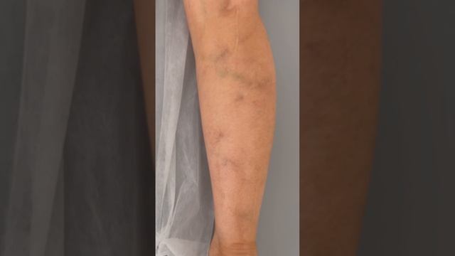 Варикоз. Как лечить варикоз? Склеротерапия. Флеболог Москва. Флеболог. Сосудистый хирург смотреть онлайн