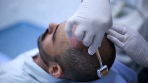 Как использовать мезороллер для восстановления волос при мужском облысении