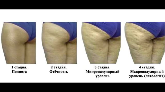 Целлюлит на задней поверхности бедра смотреть онлайн