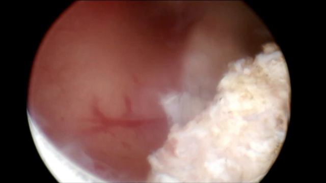 Гистерорезектоскопия. Удаление полипа эндометрия. смотреть онлайн