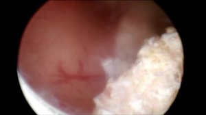 Гистерорезектоскопия. Удаление полипа эндометрия.