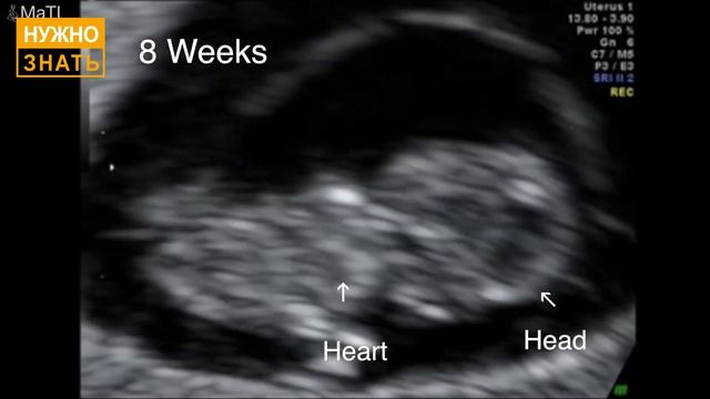 9 неделя беременности. УЗИ в 3D. Что чувствует беременная и как выглядит ребенок на 9 неделе смотреть онлайн