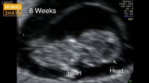 9 неделя беременности. УЗИ в 3D. Что чувствует беременная и как выглядит ребенок на 9 неделе