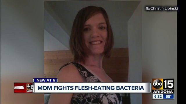 Valley mom fighting flesh-eating bacteria speaks about her battle смотреть онлайн