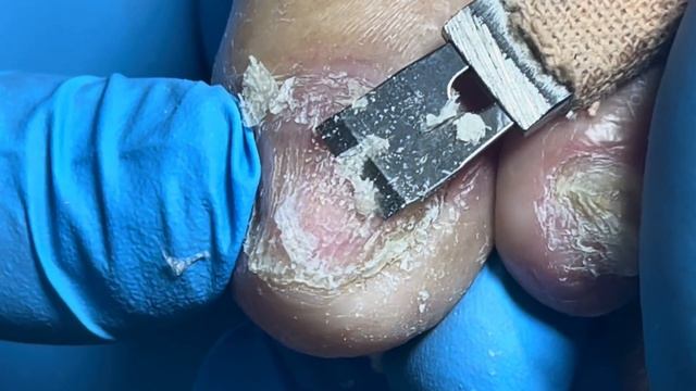 Abnormal growth of toenails, all infected with onychomycosis bacteria【Pedicure Master Lin Jun】 смотреть онлайн