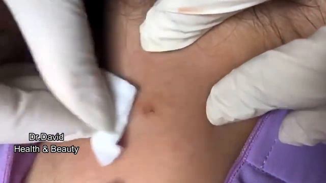 How To Get Rid Of Blackhead On Neck - How To Remove Blackhead