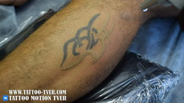 Удаление татуировки смотреть онлайн