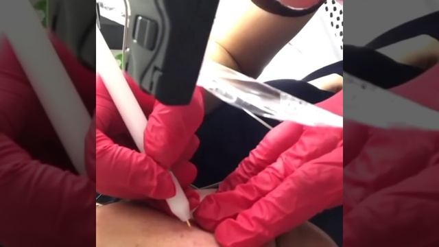 Электроэпиляция на лице смотреть онлайн