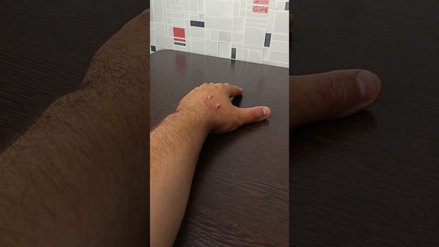 Как избавиться от укуса собаки зараженой бешенством. Последствия укуса смотреть онлайн