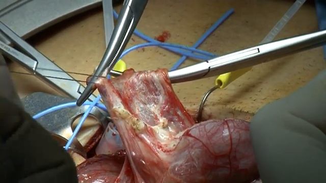 Right Radical Orchiectomy