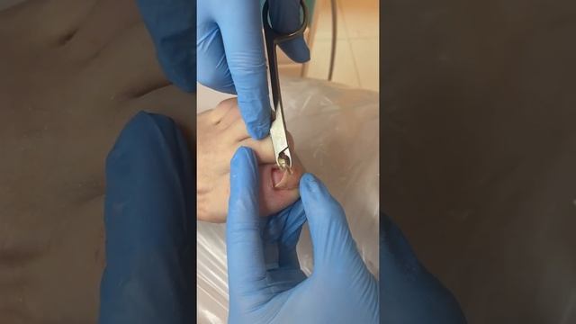 Травма . Пациент бегун марафонец. Образовалась глубокая гематома ногтевого ложа . Ноготь отслоился смотреть онлайн