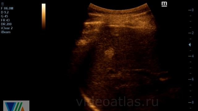 Гемангиома печени смотреть онлайн