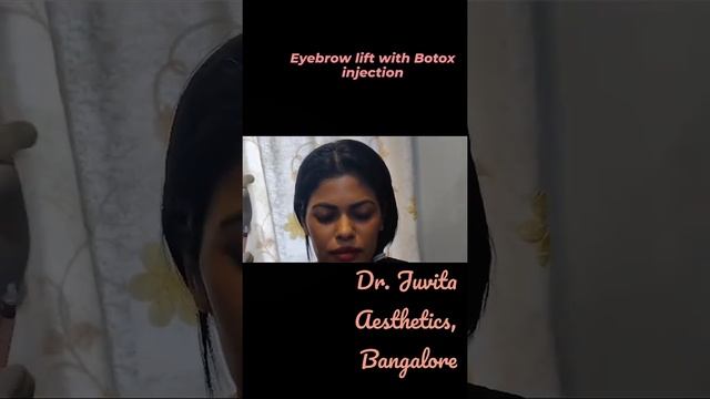 BOTOX FOR EYEBROW LIFT | DR. JUVITA AESTHETICS, BANGALORE смотреть онлайн