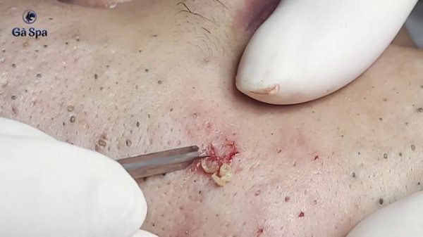 Super Blackheads Part 1 | Ga Spa| 05.02.2022