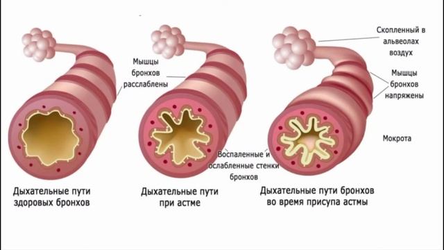 Бронхиальная астма (pt.1). Клиника. Патогенез. смотреть онлайн