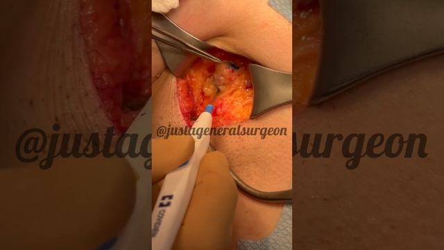 Inside the OR with @justageneralsurgeon - how we do a sentinel lymph node biopsy for breast cancer смотреть онлайн