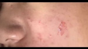 Аккуратная чистка лица. Давим прыщи - черные точки, acne blackheads. Видео с прыщами 2021